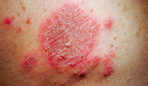 magnetisme contre eczema